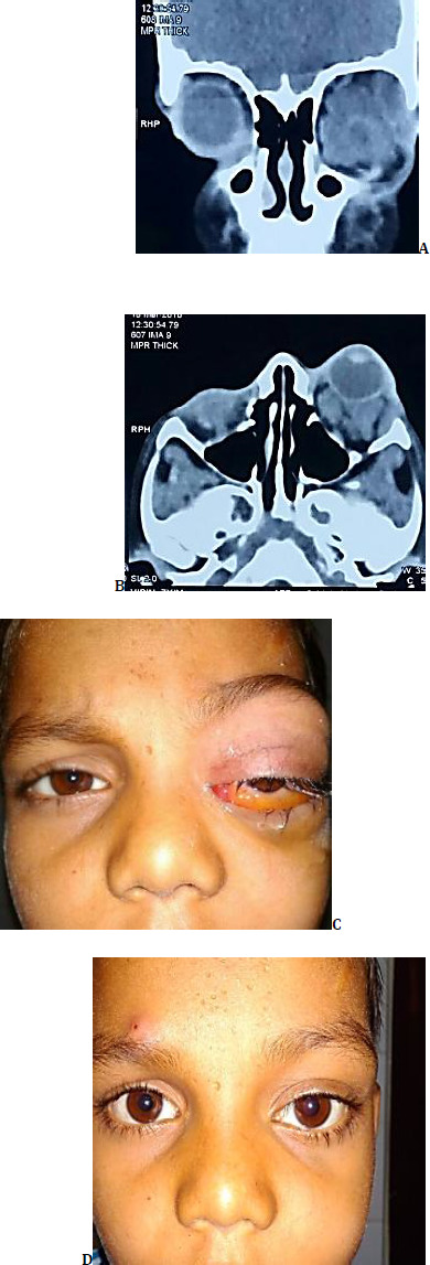 Orbital venous lymphatic malformations: case series on minimally invasive treatment approach.
