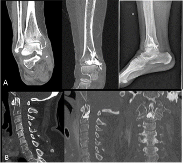 State-of-the-art of multidisciplinary approach of bone metastasis-directed therapy: review and challenging questions for preparation of a GEMO practice guidelines.