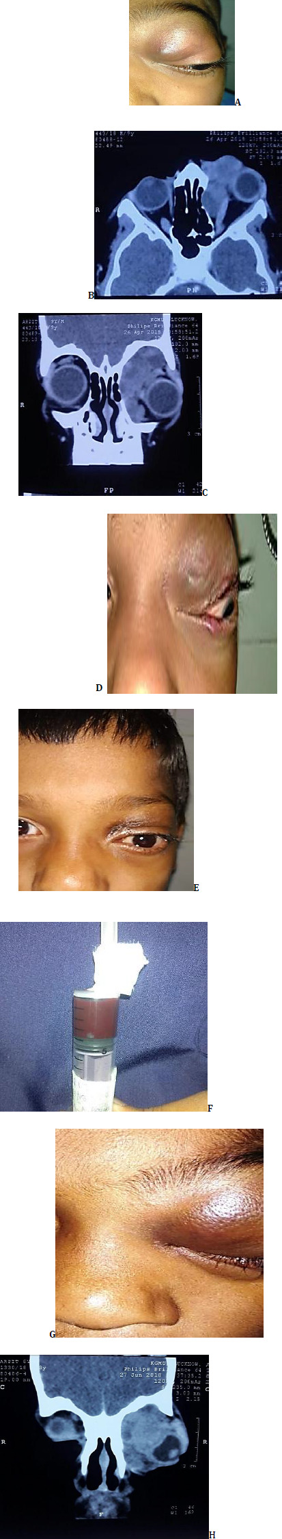 Orbital venous lymphatic malformations: case series on minimally invasive treatment approach.