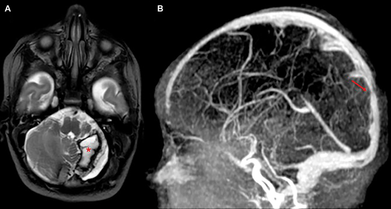 Early Enoxaparin Treatment in a Newborn with Cerebral Venous Sinus Thrombosis and Acute Cerebellar Hemorrhage.