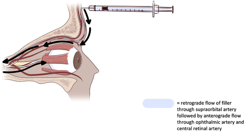 Management of vision loss associated with complications of cosmetic filler injections.