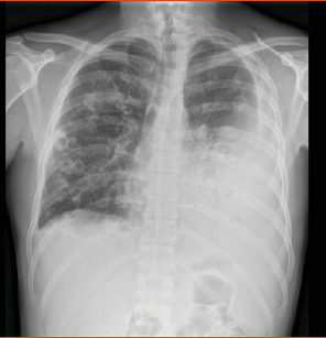 A Subtle Presentation of Pharyngitis and Pneumonia: Lemierre Syndrome.