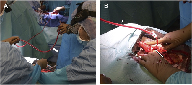 The Feasibility of a Beating-Heart Transplant From Brain-Dead Donors.