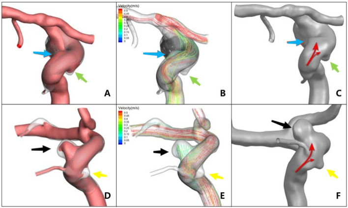 Exploration of the effect of morphology and location on hemodynamics of small aneurysms: a variable-controlled study based on two cases with tandem aneurysms.