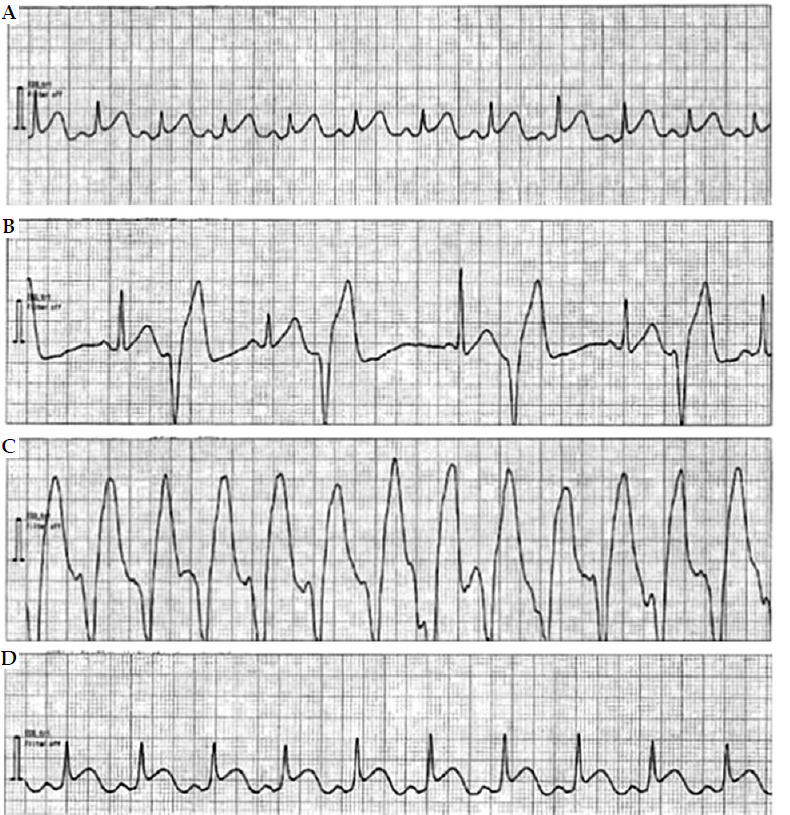 A case of acute myocardial infarction due to Kounis syndrome after brachytherapy for prostate cancer.