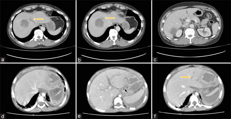 Vascular complications of amebic liver abscess - Computed tomography case series with review of the literature.