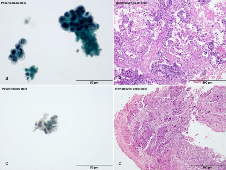 Diagnostic agreement between bronchoalveolar lavage and transbronchial lung biopsy in patients with suspected pulmonary diseases: A single-center study.