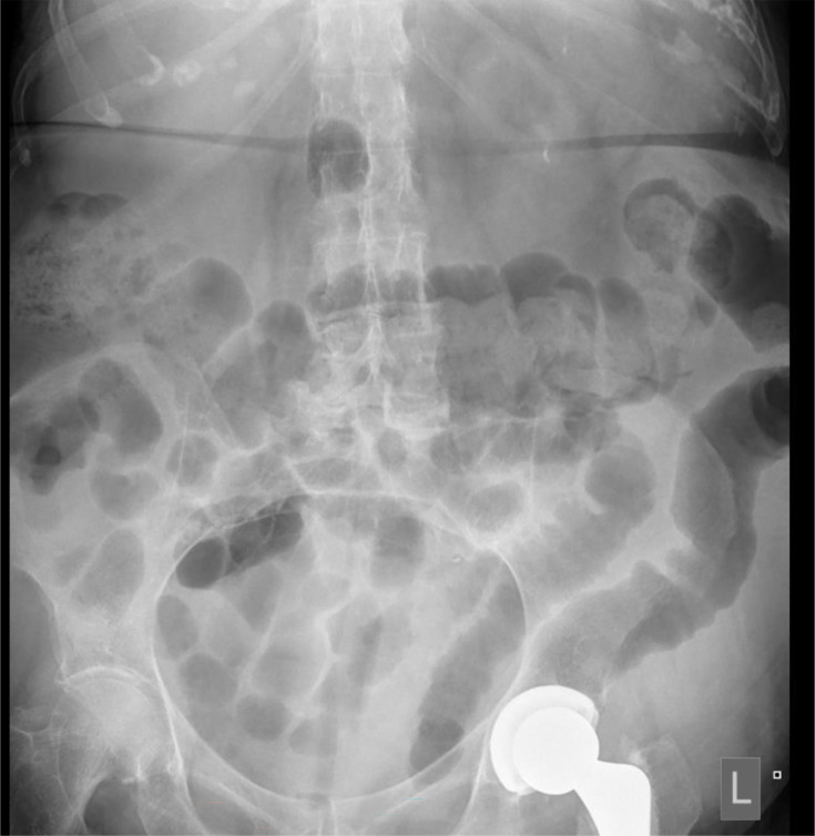 Management of severe and fulminant <i>Clostridioides difficile</i> infection in adults.