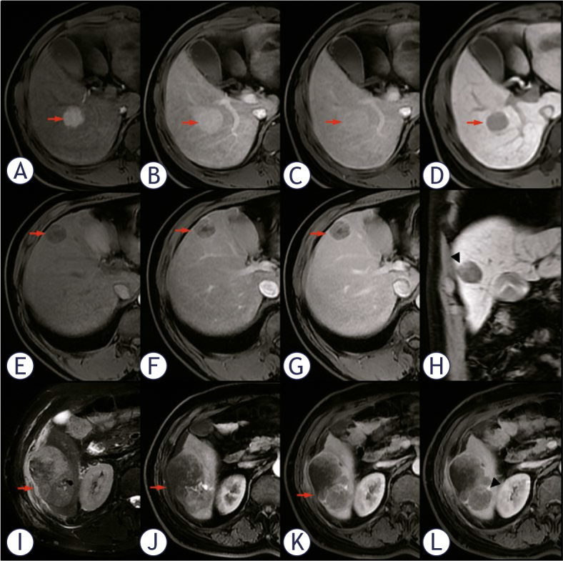 Evaluating the severity of microvascular invasion in hepatocellular carcinoma, by probing the combination of enhancement modes and growth patterns through magnetic resonance imaging.