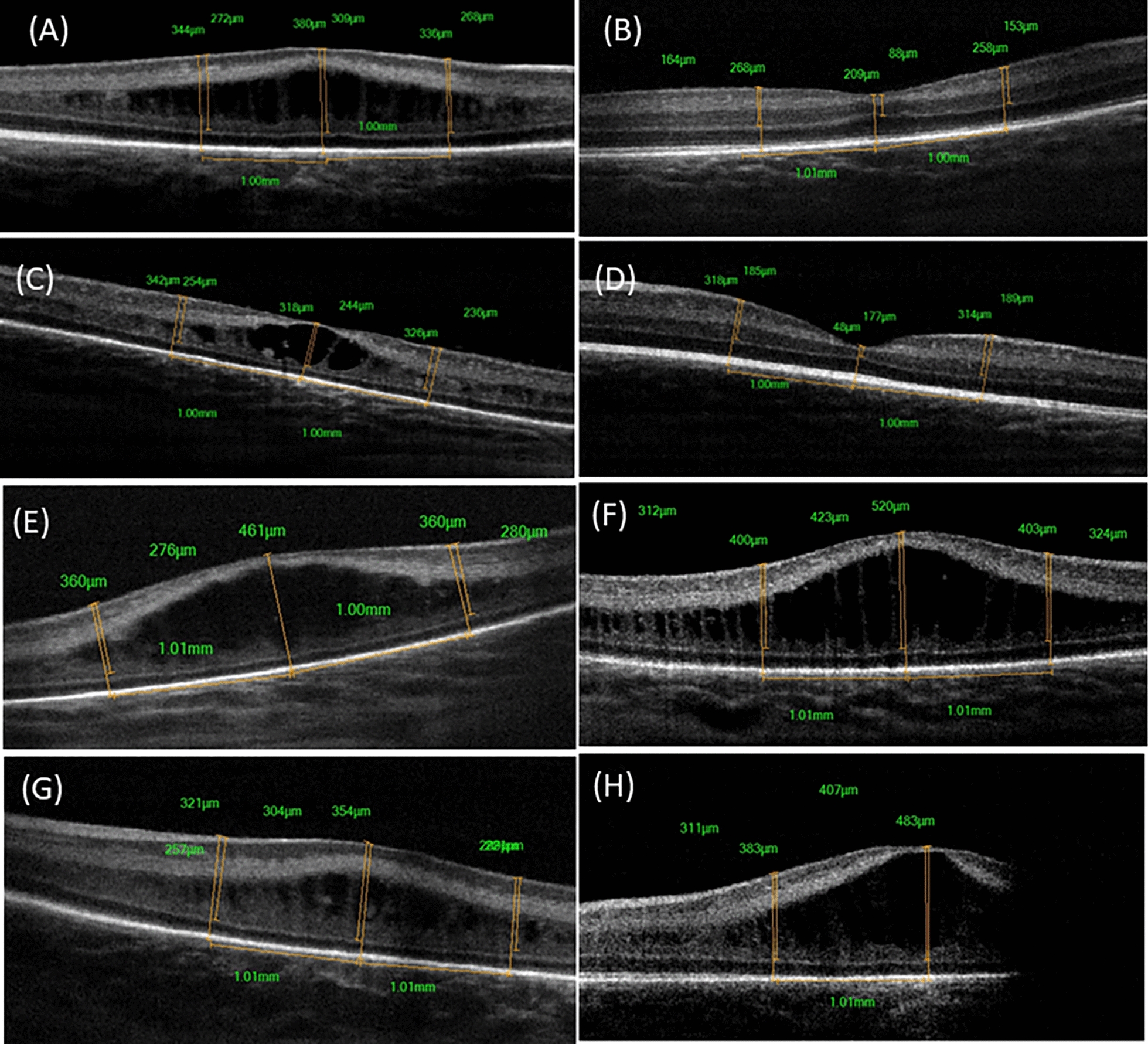 OCT macular changes in type 1 ROP following Ranibizumab injections.