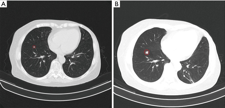 Chronic myeloid leukemia in a patient treated with palbociclib and exemestane: a case report.