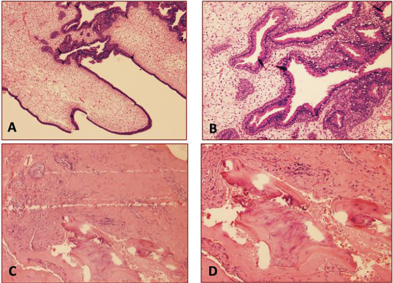 Chondro-Osseous Respiratory Epithelial Adenomatoid Hamartoma of the Skull Base: Report of a Case and Literature Review.