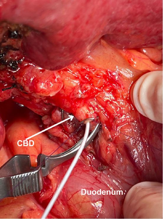 STANDARDIZATION OF THE WHITE TEST IN OPEN LIVER RESECTION: TOWARD NEAR-ZERO CLINICALLY SIGNIFICANT BILE LEAKAGE.