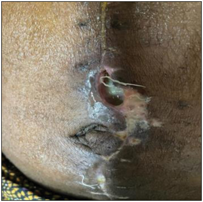 Perception and Role of Indirect and Post-Discharge Surveillance in Predicting Surgical Site Infection in Surgical Patients: An Institutional Experience.