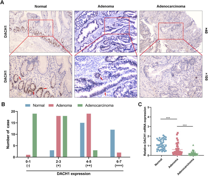 Aberrant DNMT1-mediated DACH1 methylation is associated with colorectal adenoma-to-carcinoma progression.