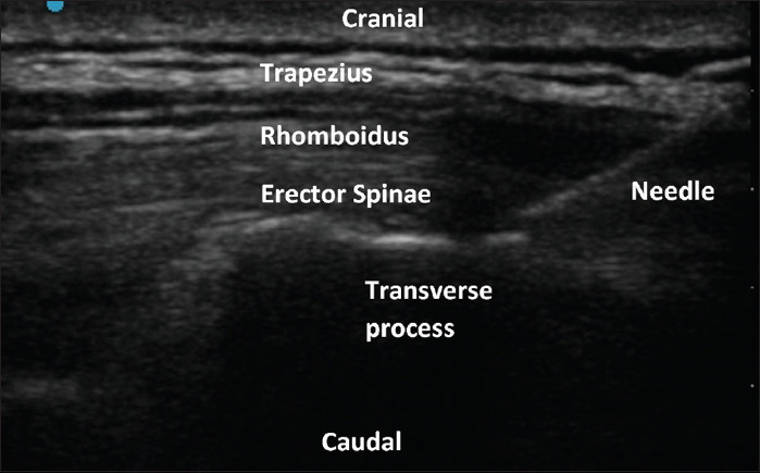 Comparison of intravenous with perineural dexamethasone for ultrasound-guided erector spinae plane block in patients undergoing modified radical mastectomy-A randomized control trial.