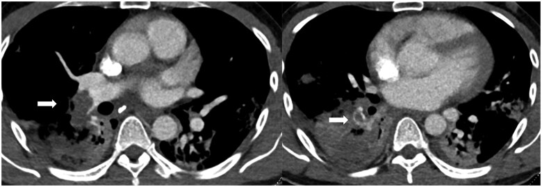 Non-invasive imaging in acute and chronic pulmonary embolism.