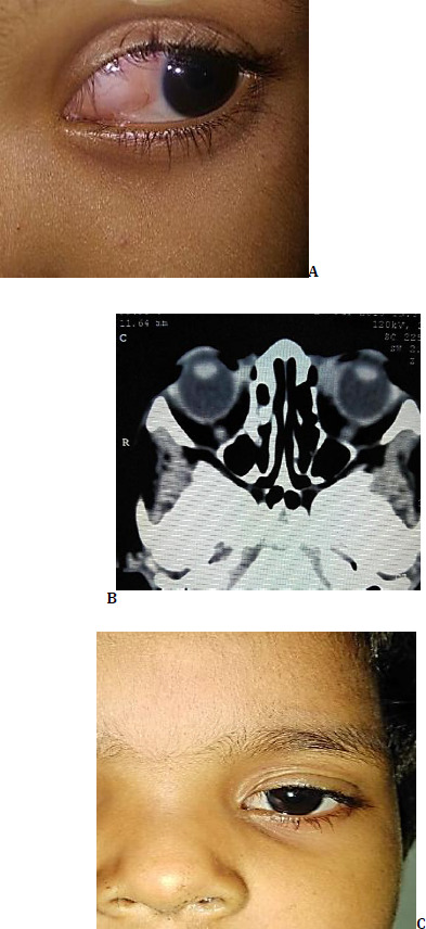 Orbital venous lymphatic malformations: case series on minimally invasive treatment approach.