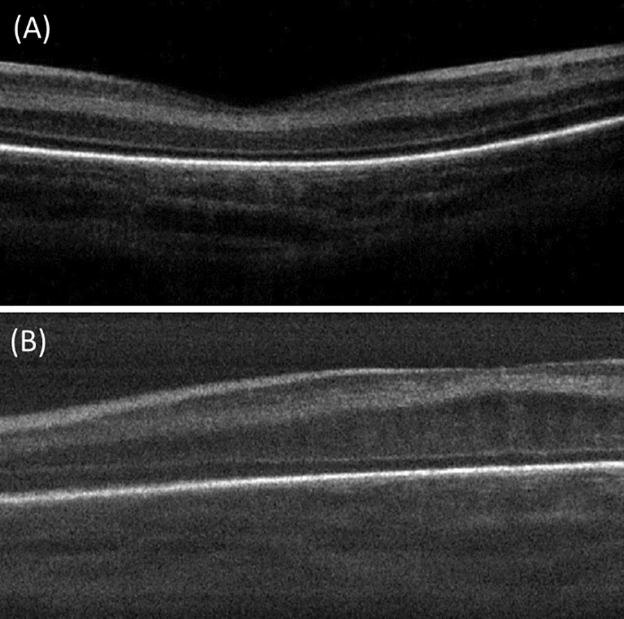 OCT macular changes in type 1 ROP following Ranibizumab injections.