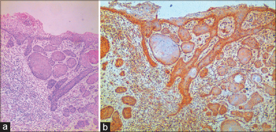 Fibulin-4 expression in potentially malignant disorders and squamous cell carcinoma of oral mucosa-An immunohistochemical study.