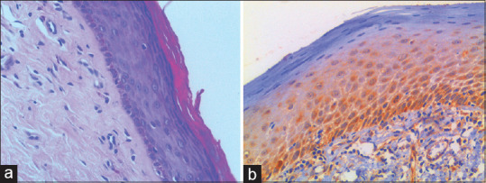 Fibulin-4 expression in potentially malignant disorders and squamous cell carcinoma of oral mucosa-An immunohistochemical study.