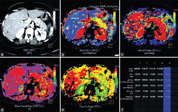 Early perfusion computed tomography in severe acute pancreatitis: Predicting necrosis and guiding care.