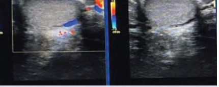 Regional distribution of intratesticular varicoceles accompanying extratesticular varicocele cases.