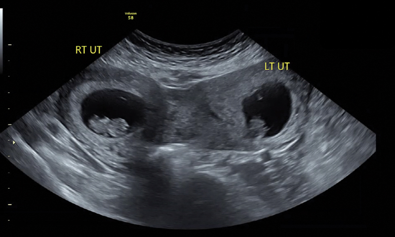 Di-Cavitary Twin Pregnancy in Didelphys Uterus with Associated Renal Agenesis.