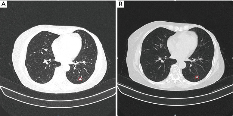 Chronic myeloid leukemia in a patient treated with palbociclib and exemestane: a case report.