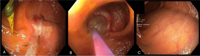 First description of endoscopic dilation of stricturing Kono-S anastomosis in Crohn's disease.