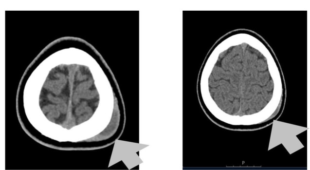 Spontaneous subgaleal haematoma with severe headache in two children during acute painful sickle cell crisis.