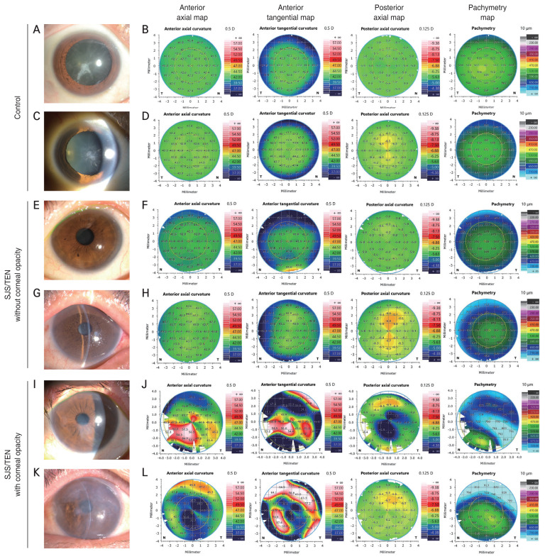 Anterior Segment Swept-Source Optical Coherence Tomography-based Assessment of Corneal Refractive Profiles in Stevens-Johnson Syndrome/Toxic Epidermal Necrolysis Patients: A Controlled Comparative Study.