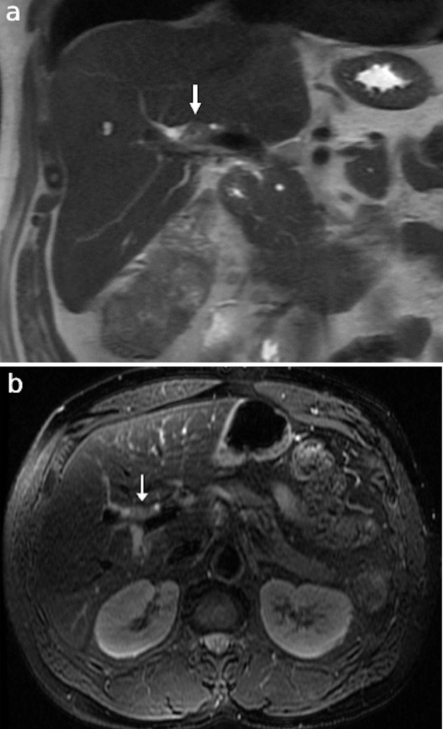 Solitary Synchronous Biliary Metastasis in Colorectal Adenocarcinoma.