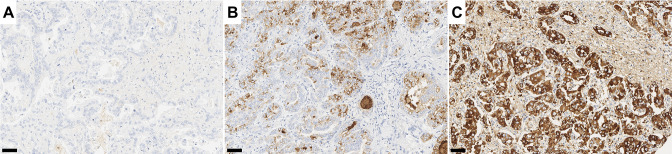 Combined analysis of albumin in situ hybridisation and C reactive protein immunohistochemistry for the diagnosis of intrahepatic cholangiocarcinoma: towards a molecular classification paradigm.