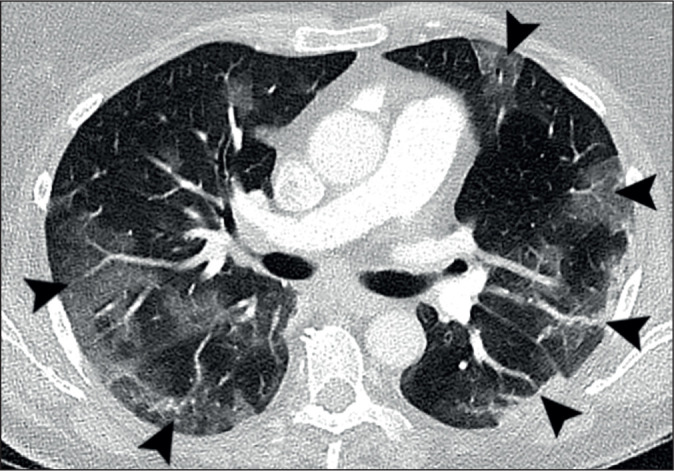 Chest computed tomography and plain radiographs demonstrate vascular distribution and characteristics in COVID-19 lung disease - a pulmonary vasculopathy.
