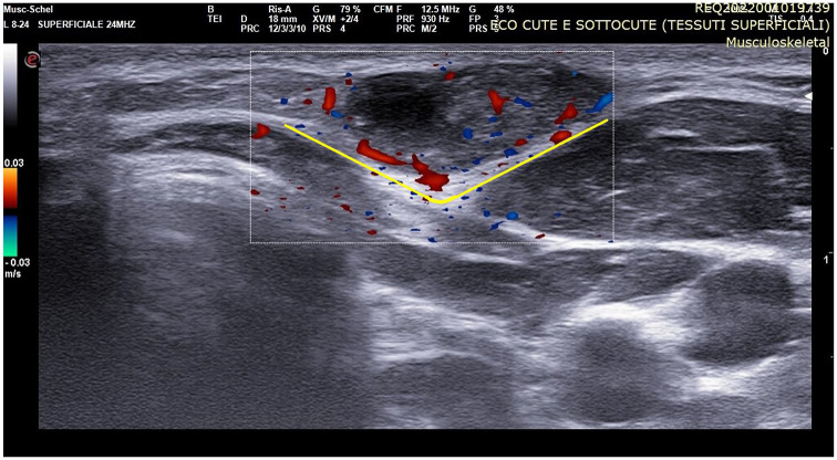 Pilomatricomas in a patient with Rubinstein-Taybi syndrome: diagnostic and therapeutic clues.