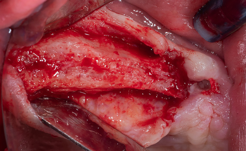 Case Report: A new modification of Loma Linda pouch technique.