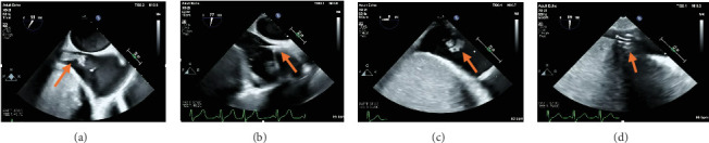 Repeat AngioVac Debulking of a Large Right Atrial Thrombus With Extension From the Hepatic Vein.