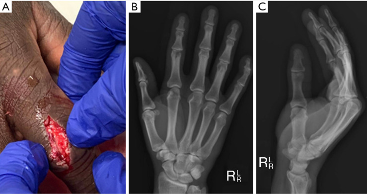 Osteochondral autograft from the second toe for complex proximal interphalangeal joint fracture-dislocations: a case report and literature review.