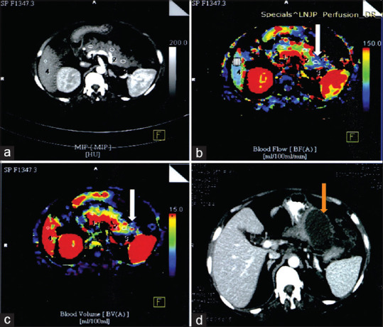 Early perfusion computed tomography in severe acute pancreatitis: Predicting necrosis and guiding care.