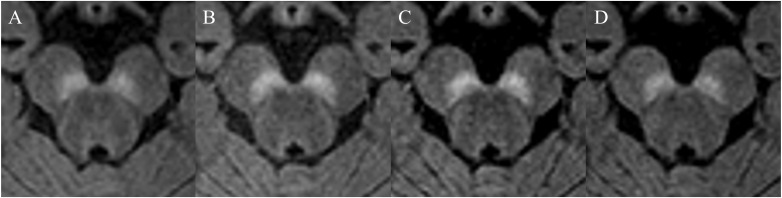 Comparison of 3D Magnetization-transfer- and Spectral-presaturation-with-inversion-recovery-based Neuromelanin Imaging.