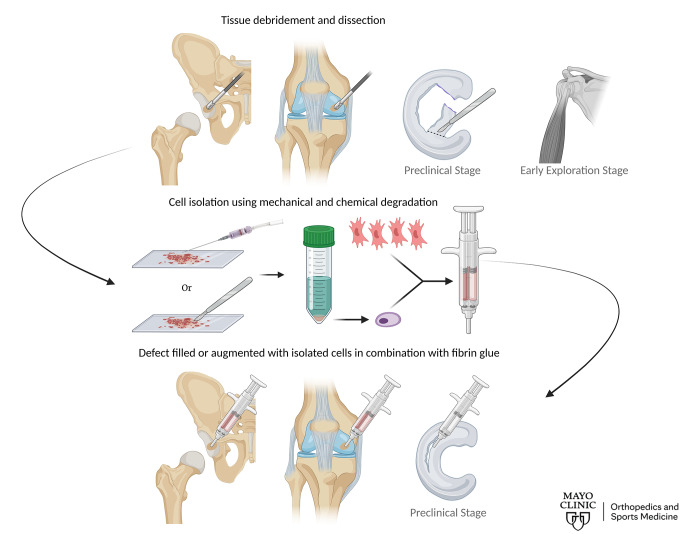 From IMPACT to RECLAIM: A Single-Stage Cell Therapy for Articular Cartilage Repair and a Platform for Musculoskeletal Tissue Regeneration.