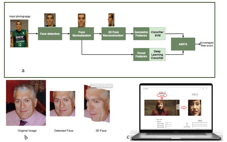 Acromegaly facial changes analysis using last generation artificial intelligence methodology: the AcroFace system.