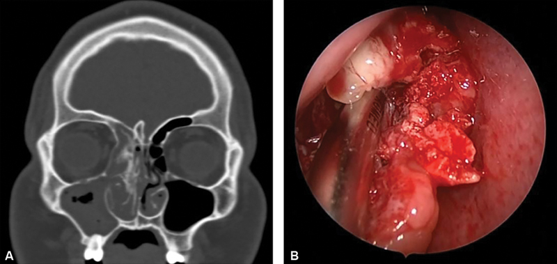 Chondro-Osseous Respiratory Epithelial Adenomatoid Hamartoma of the Skull Base: Report of a Case and Literature Review.