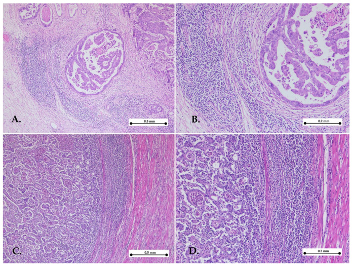 Prognostic Impact of Klintrup-Mäkinen (KM) Score in Gastric Cancer and Its Association with Pathological Parameters.