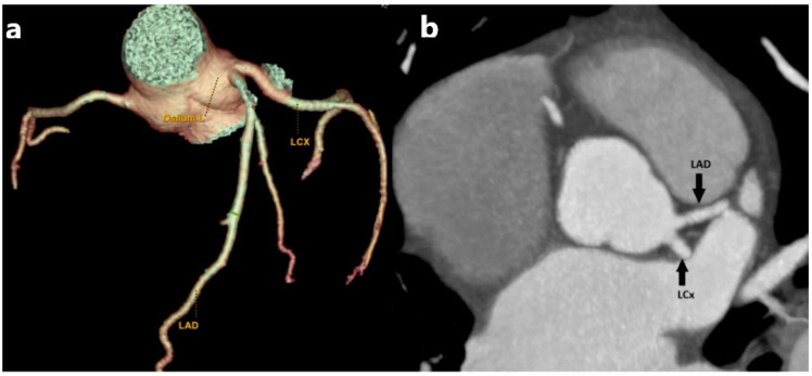 The Role of MDCT Coronary Angiography in the Detection of Benign Varieties and Anomalies of Coronary Blood Vessels-A Narrative Review.