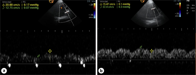 Emergency Renal Replacement Therapy with Manual Dialysis in Patients with Acute Kidney Injury: First-in-Human Case Report.