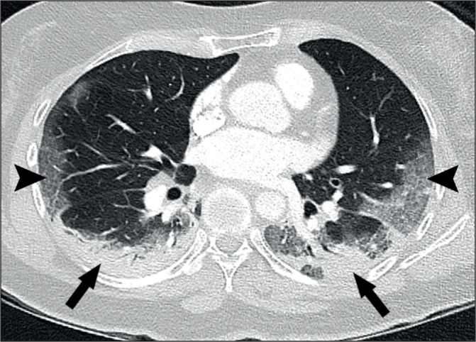 Chest computed tomography and plain radiographs demonstrate vascular distribution and characteristics in COVID-19 lung disease - a pulmonary vasculopathy.