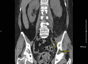 Recurrent Urosepsis Following Stent Removal for Ureteral Stones: A Case Report.