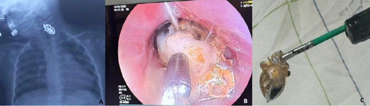 Earring ingestion in a twelve-month-old infant.